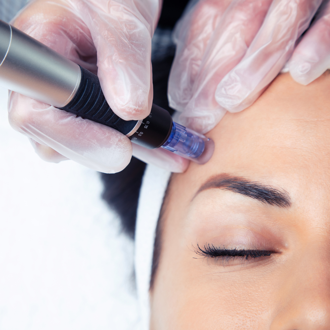Microneedling Including Mesotherapy